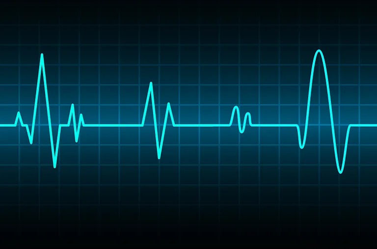 ECG Signal Processing